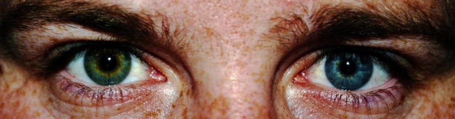 Heterochromia Iridis: A Genetic Disease